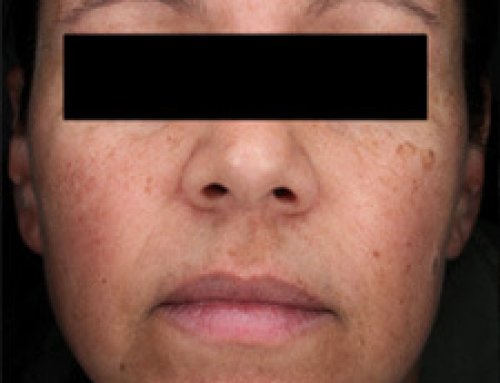 What is a Visia Skin Scan?